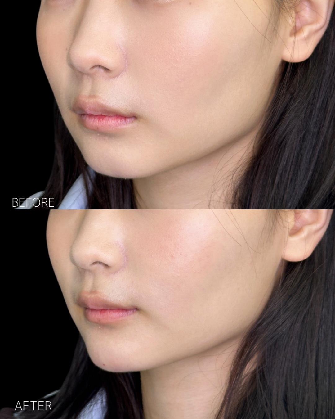 アゴクレヴィエルの症例写真