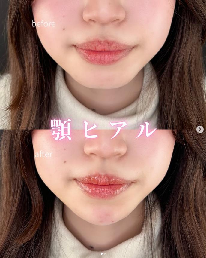 アゴクレヴィエルの症例写真