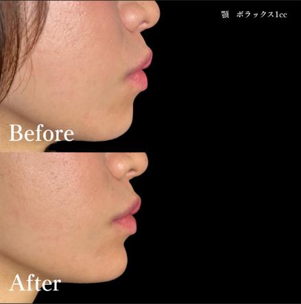 アゴクレヴィエルの症例写真