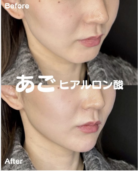 アゴクレヴィエルの症例写真