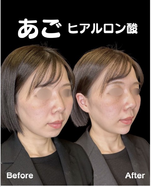 アゴクレヴィエルの症例写真