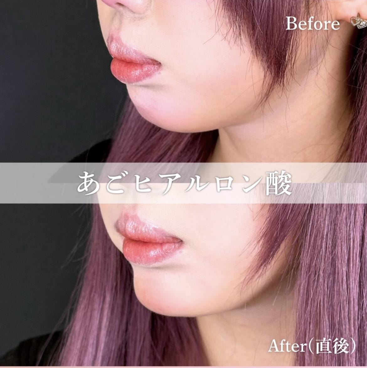 アゴクレヴィエルの症例写真