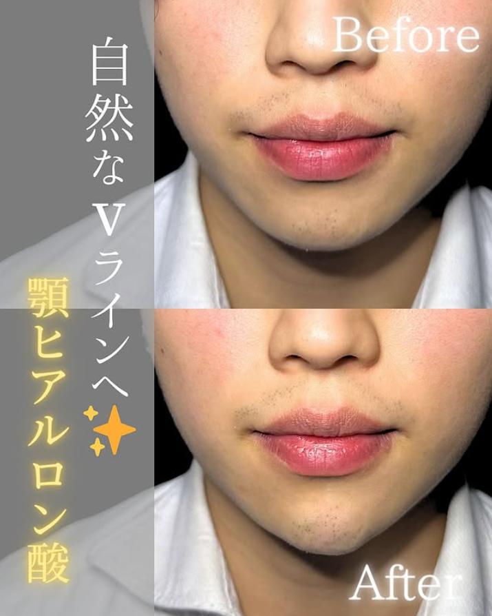 アゴクレヴィエルの症例写真