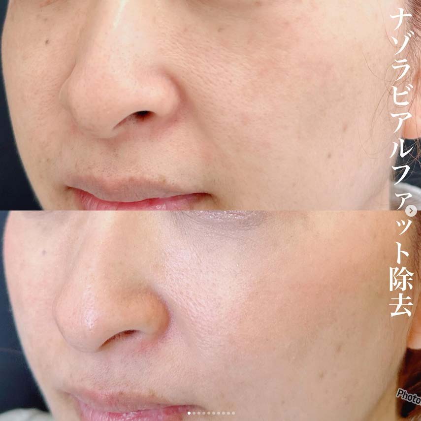 メーラーファット除去の症例写真