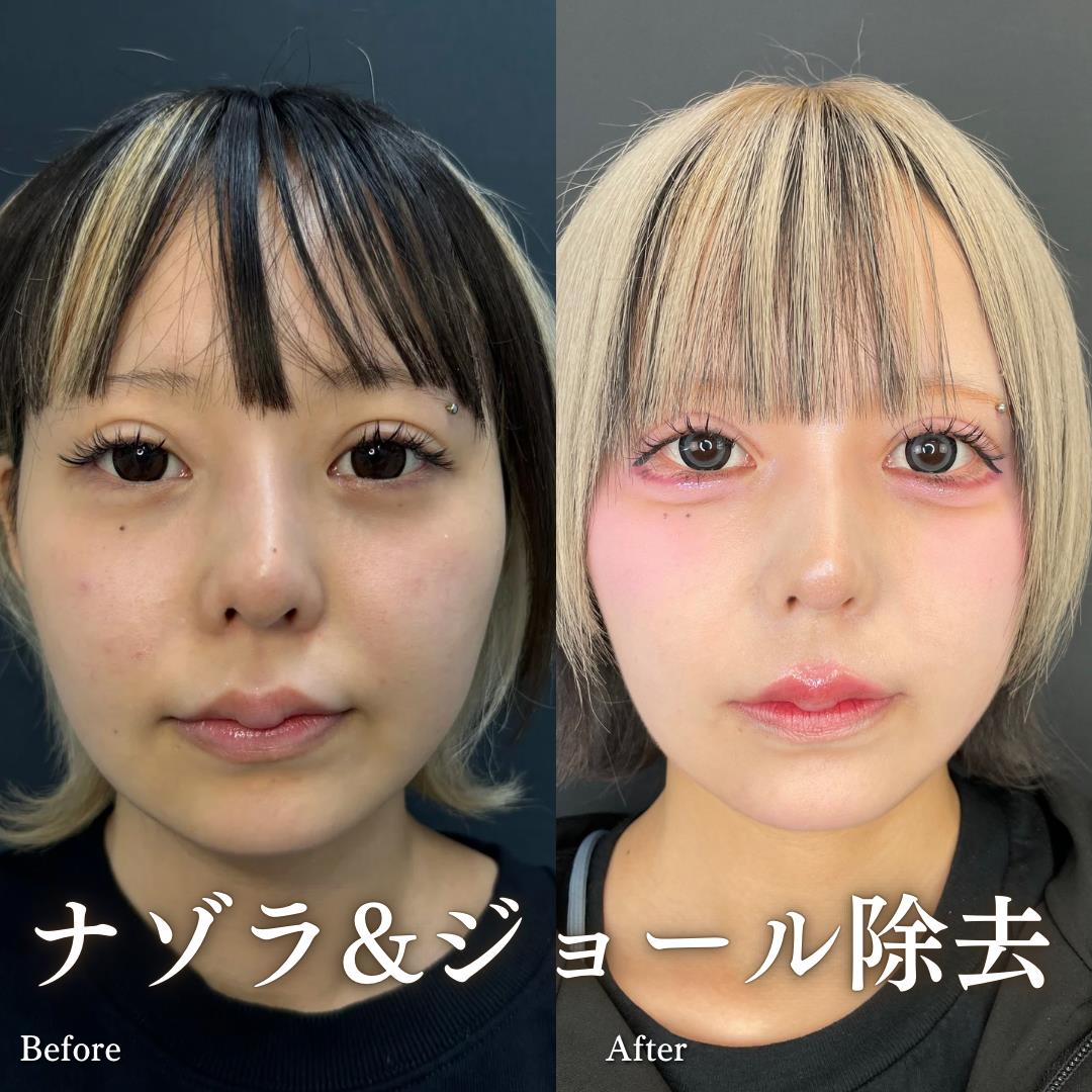 メーラーファット除去の症例写真