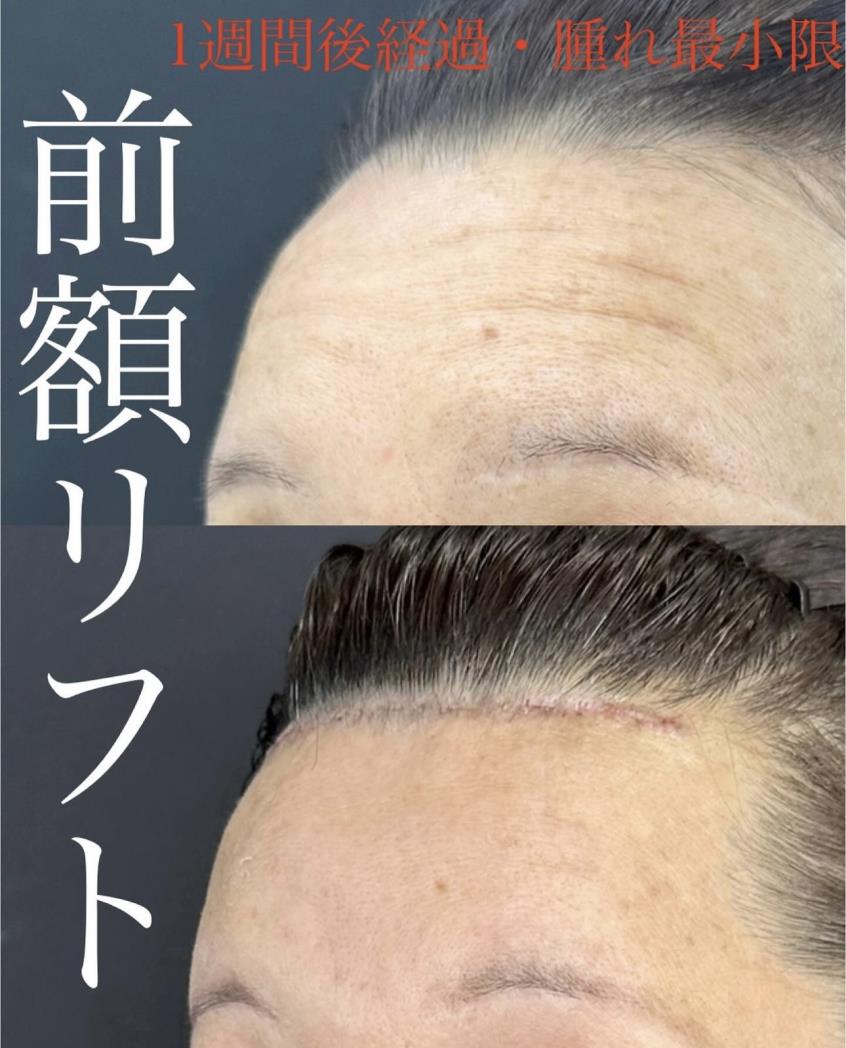 前額リフトの症例写真