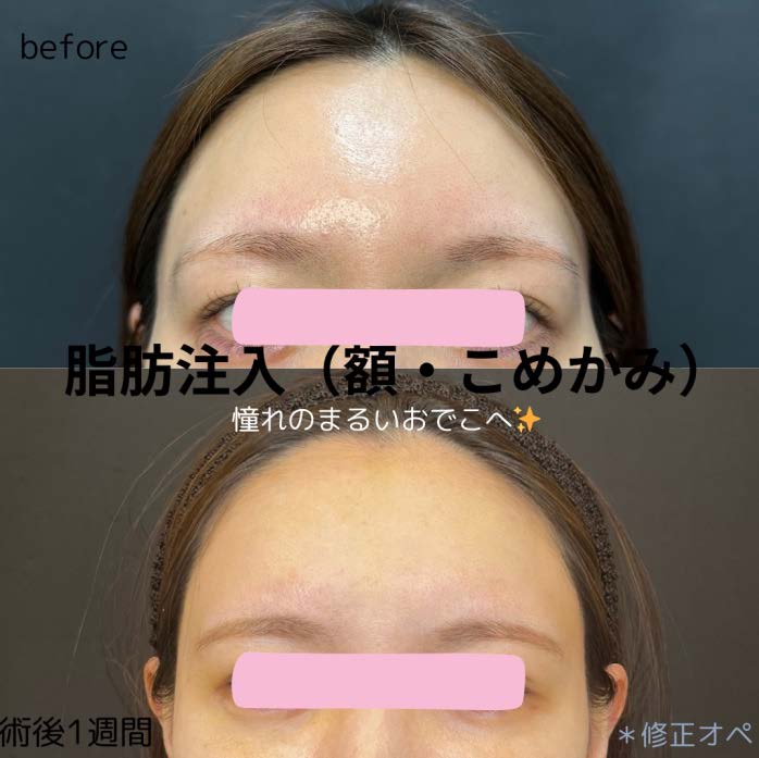 脂肪注入の症例写真
