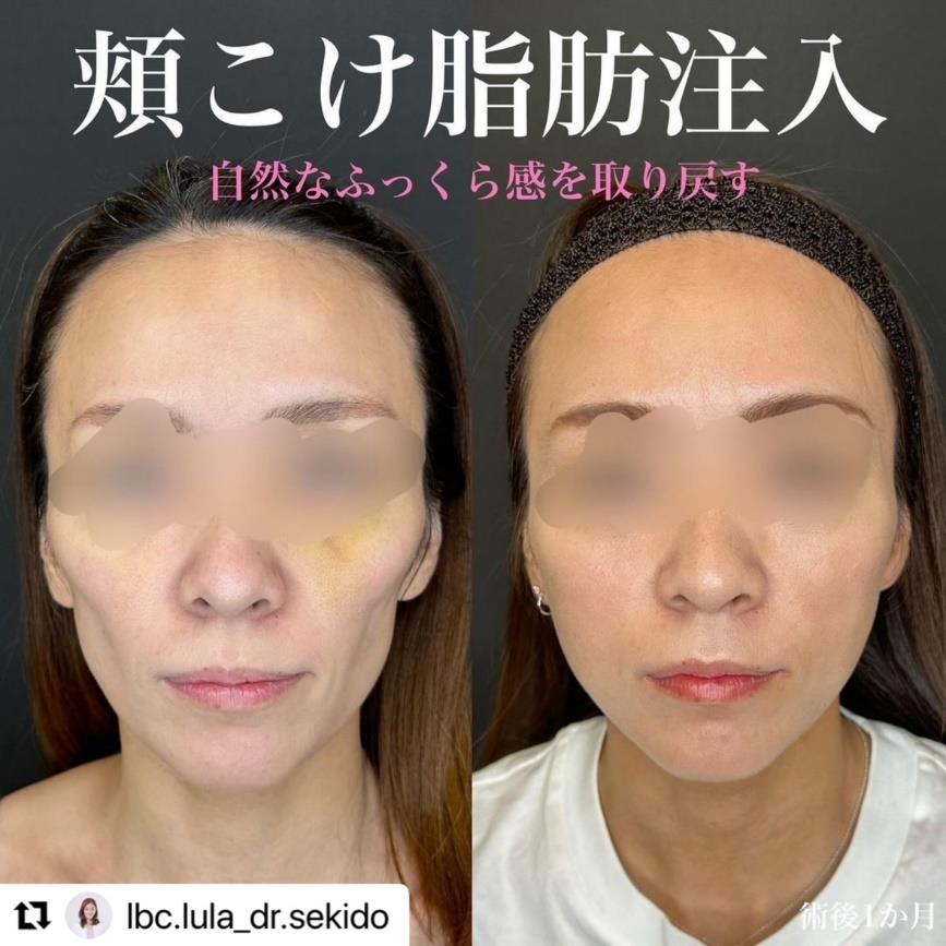 脂肪注入の症例写真