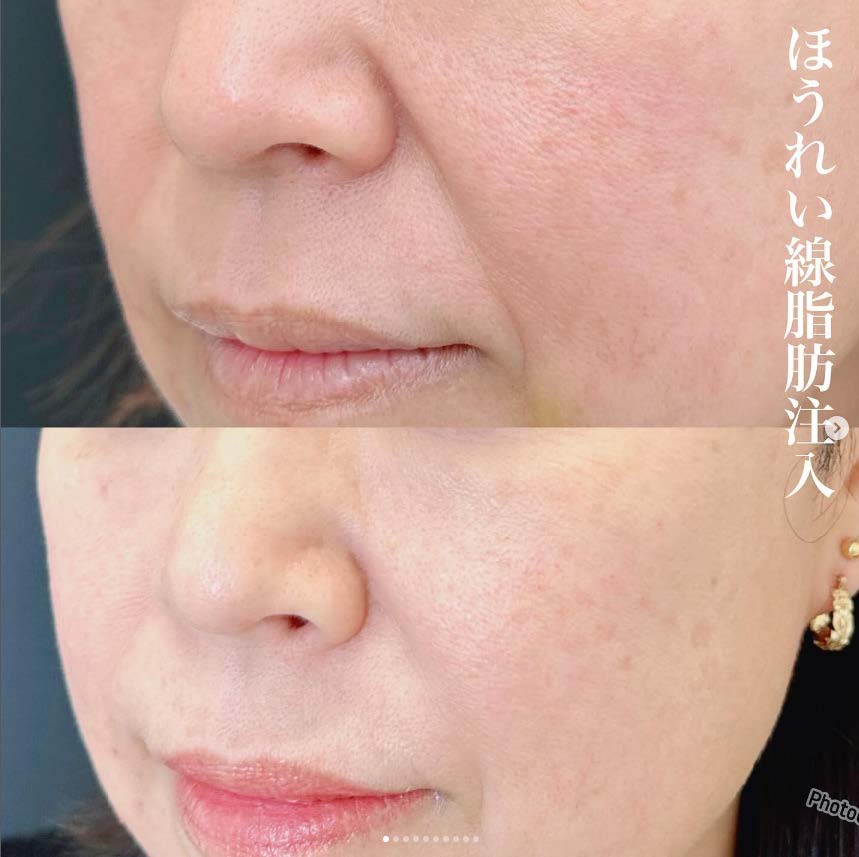 脂肪注入の症例写真