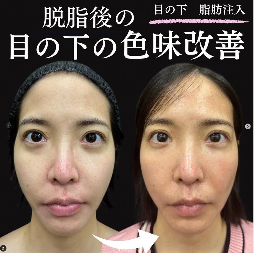 脂肪注入の症例写真