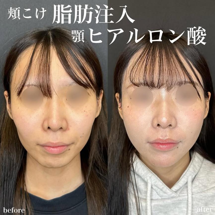 脂肪注入の症例写真