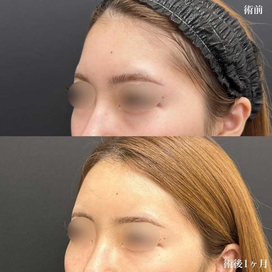 脂肪注入の症例写真