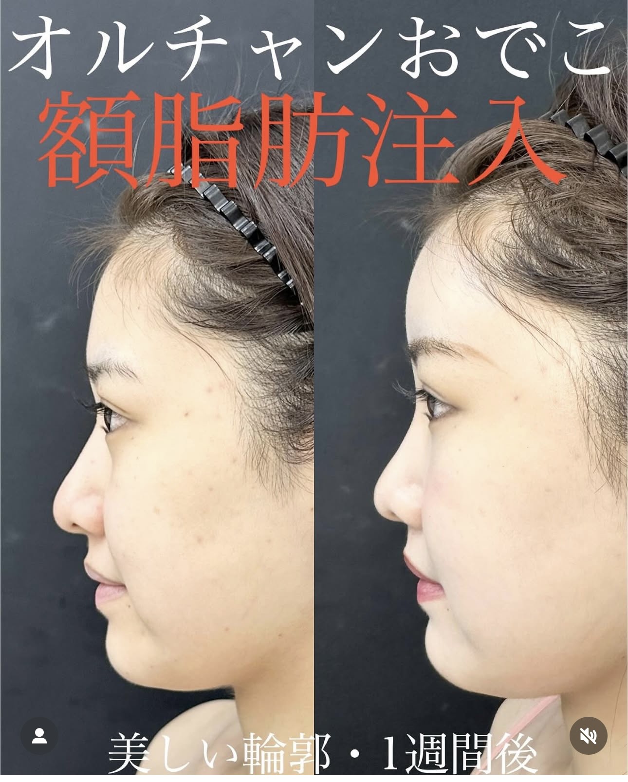 脂肪注入の症例写真