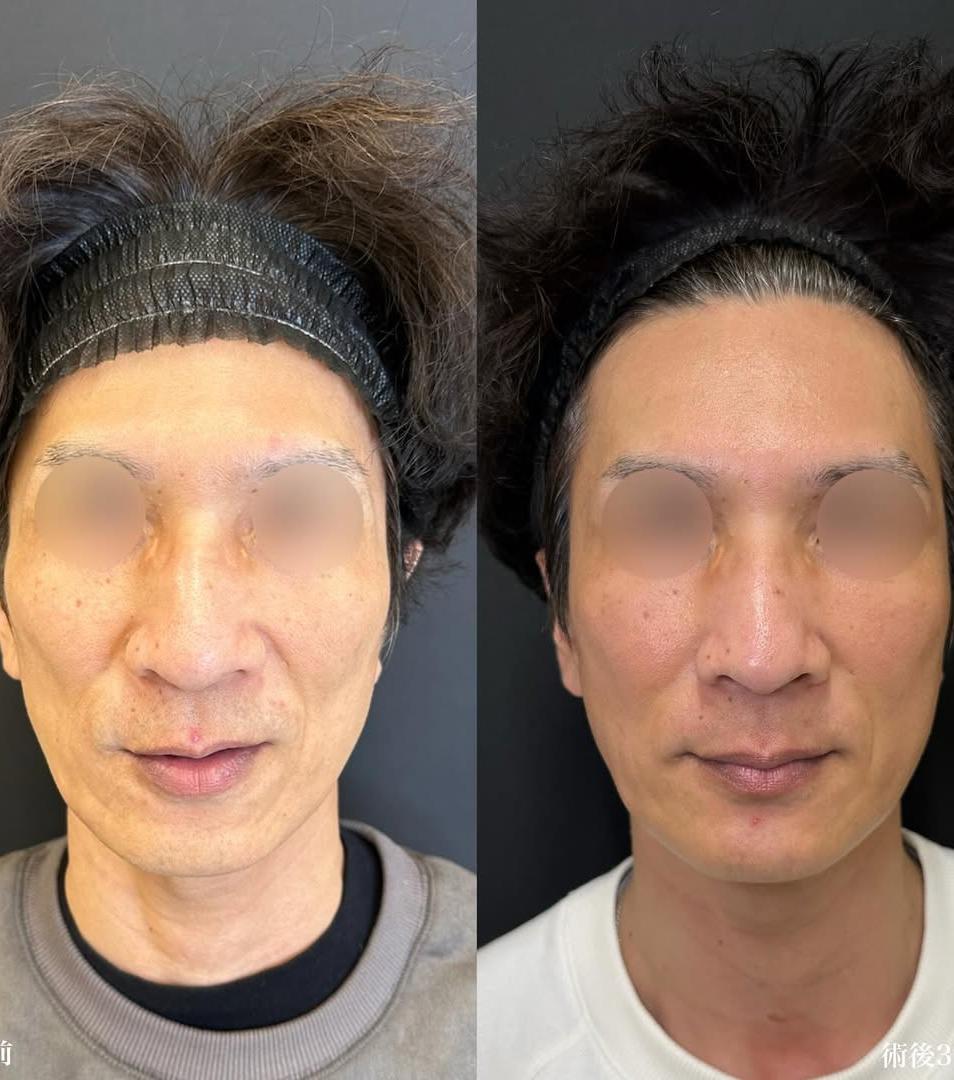 脂肪注入の症例写真