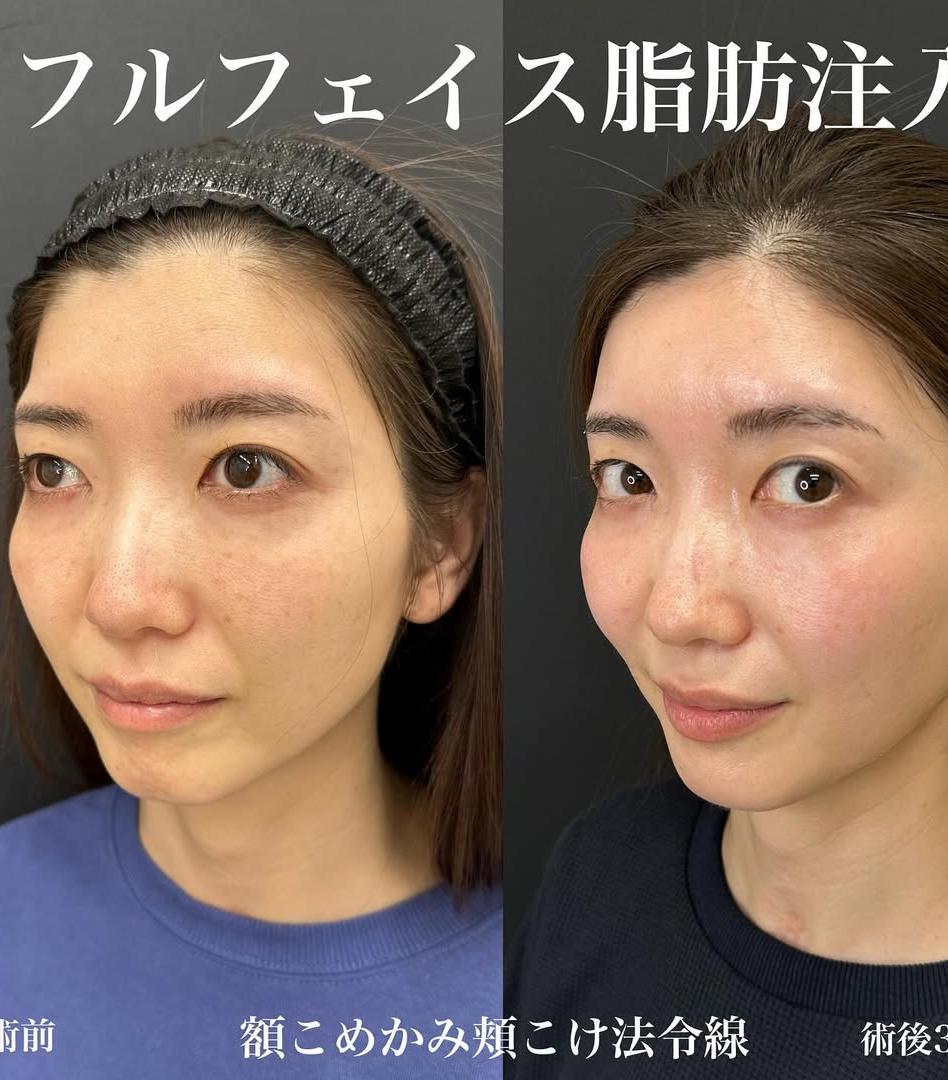 脂肪注入の症例写真