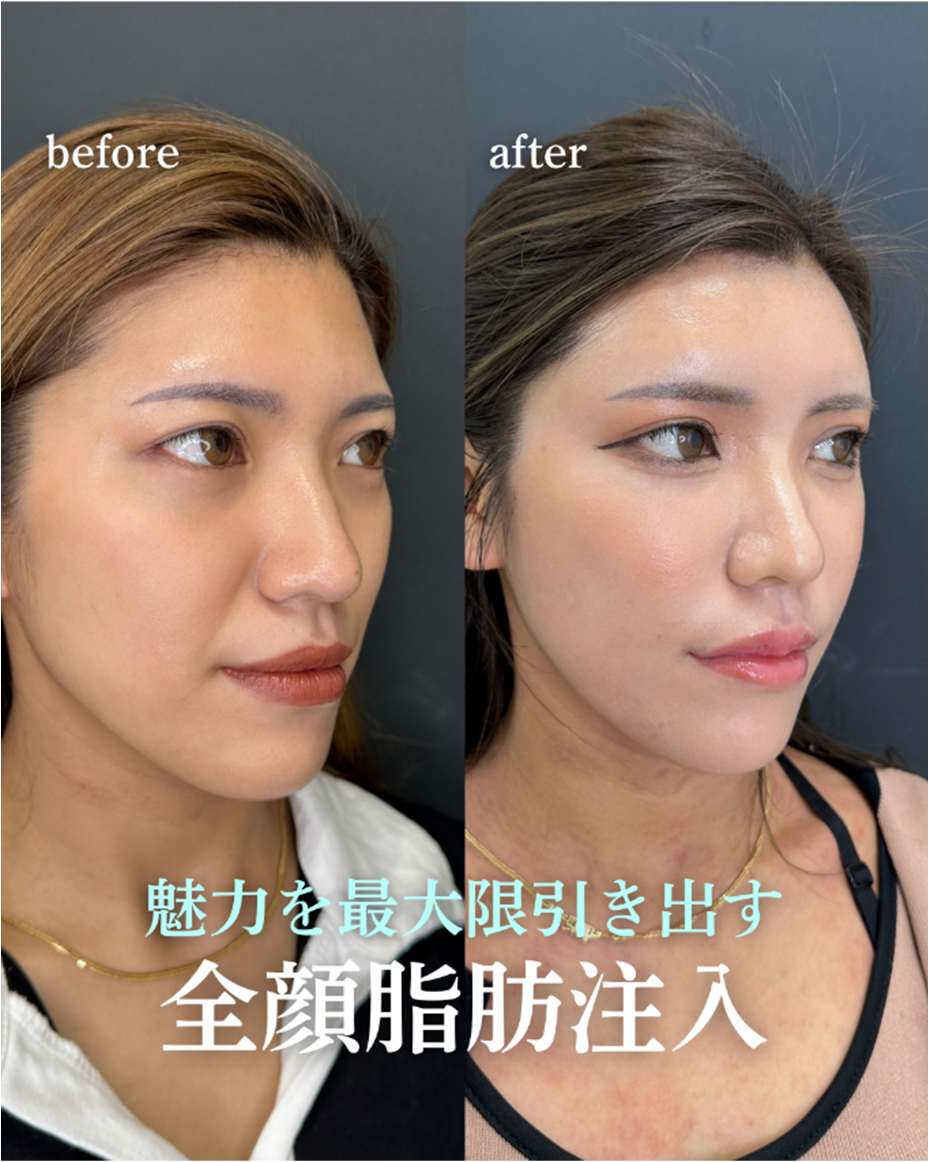 脂肪注入の症例写真