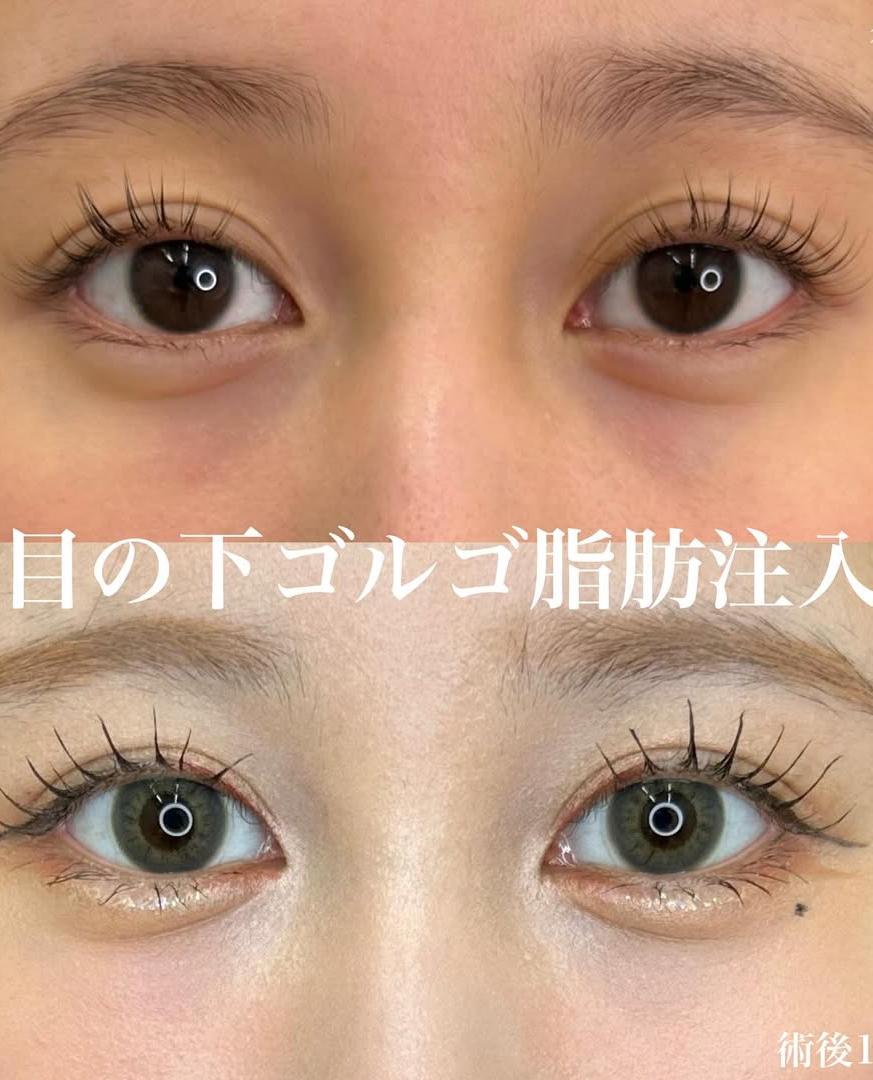 脂肪注入の症例写真