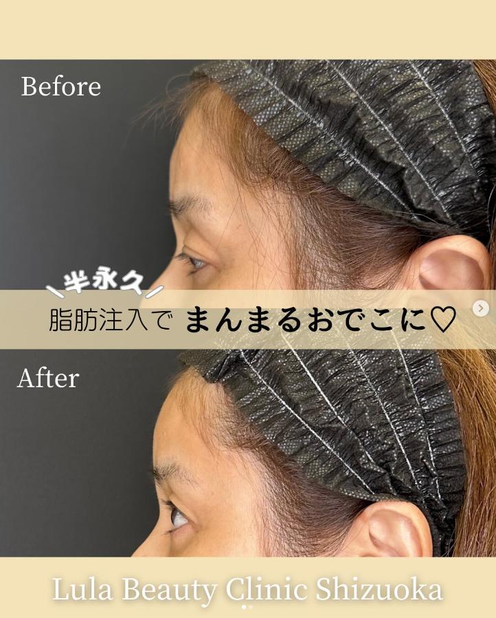 脂肪注入の症例写真