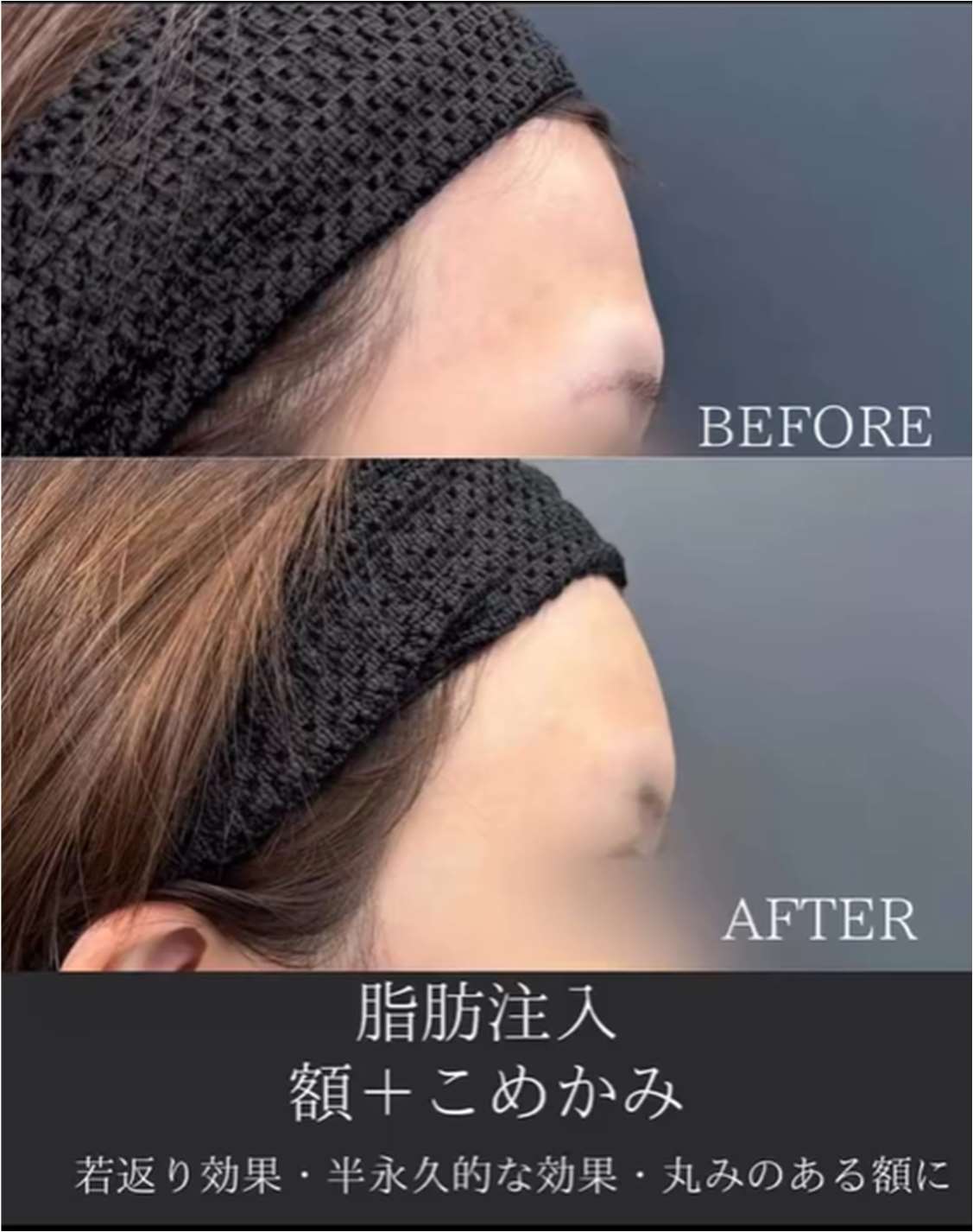 脂肪注入の症例写真