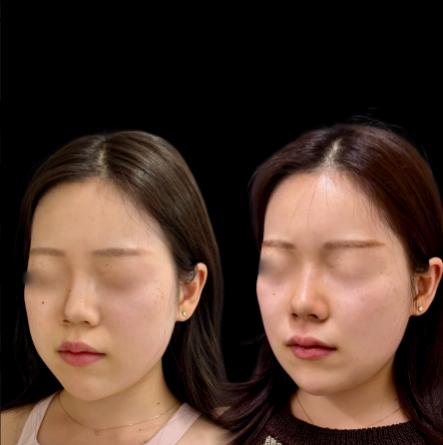 ヒアルロン酸の症例写真