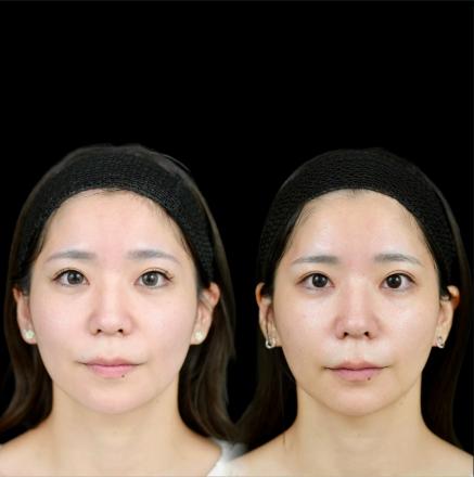 ヒアルロン酸の症例写真