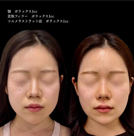 ヒアルロン酸の症例写真