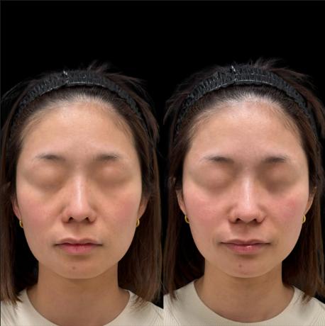 ヒアルロン酸の症例写真