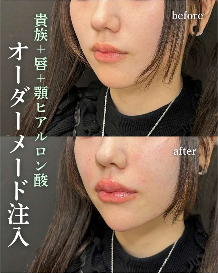 ヒアルロン酸の症例写真