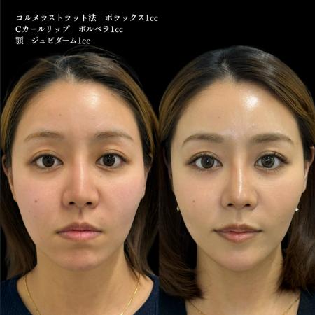 ヒアルロン酸の症例写真