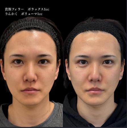 ヒアルロン酸の症例写真