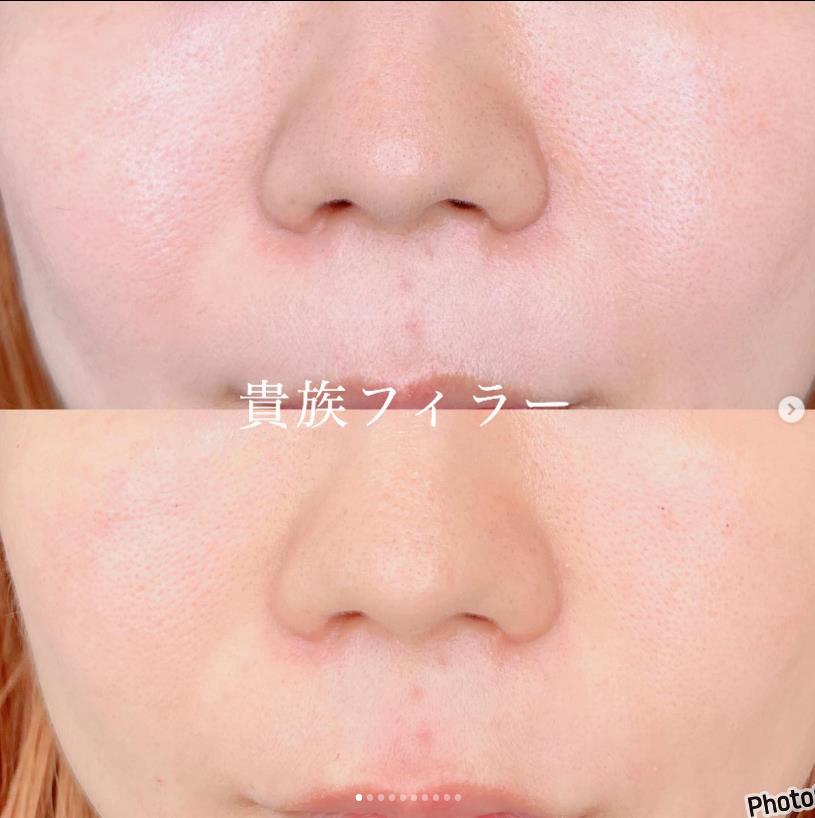 貴族フィラーの症例写真