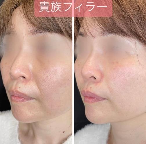 貴族フィラーの症例写真