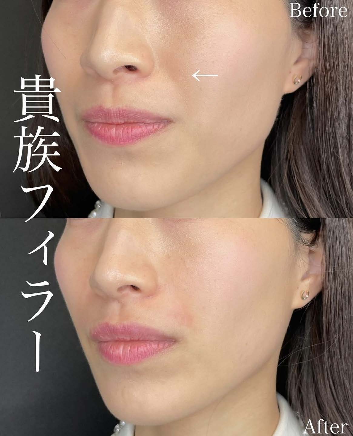 ヒアルロン酸の症例写真