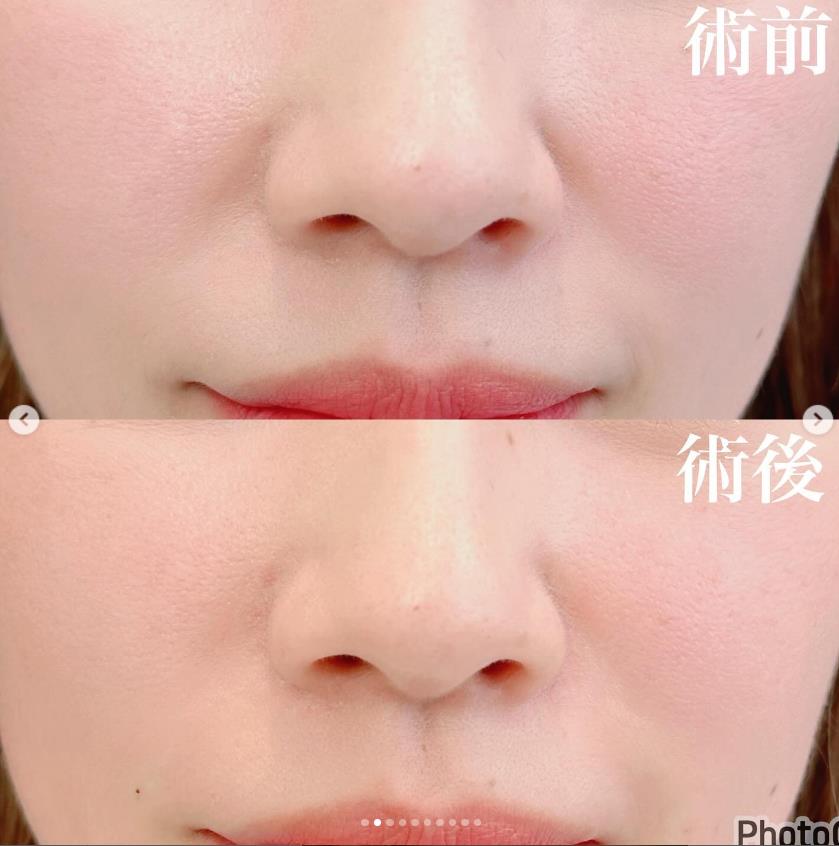貴族フィラーの症例写真