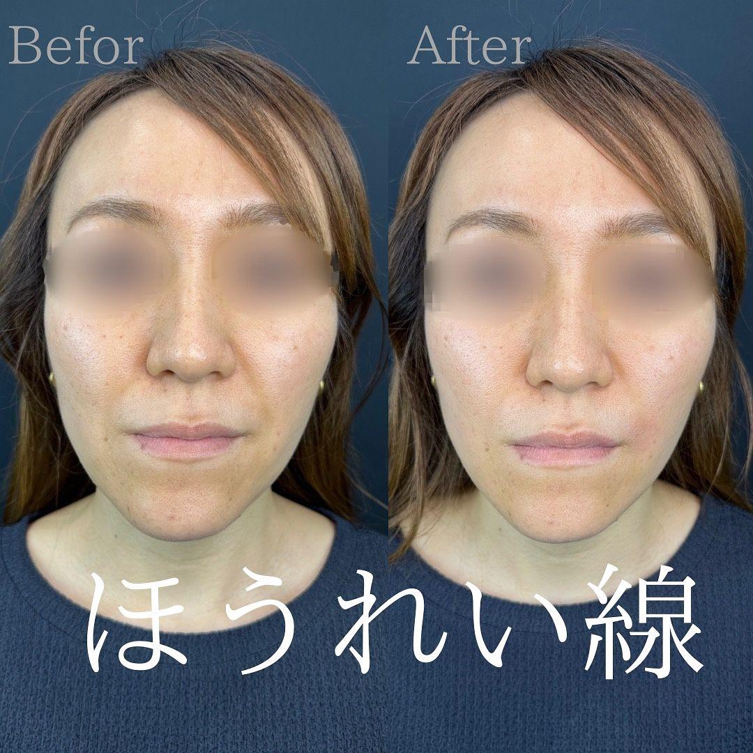 ヒアルロン酸の症例写真