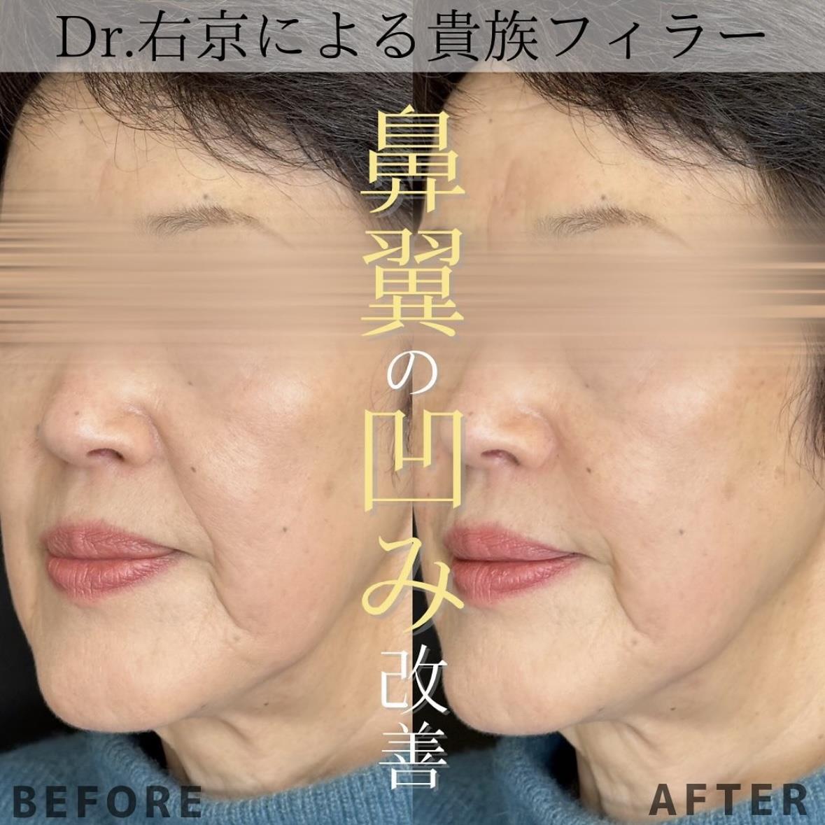 ヒアルロン酸の症例写真
