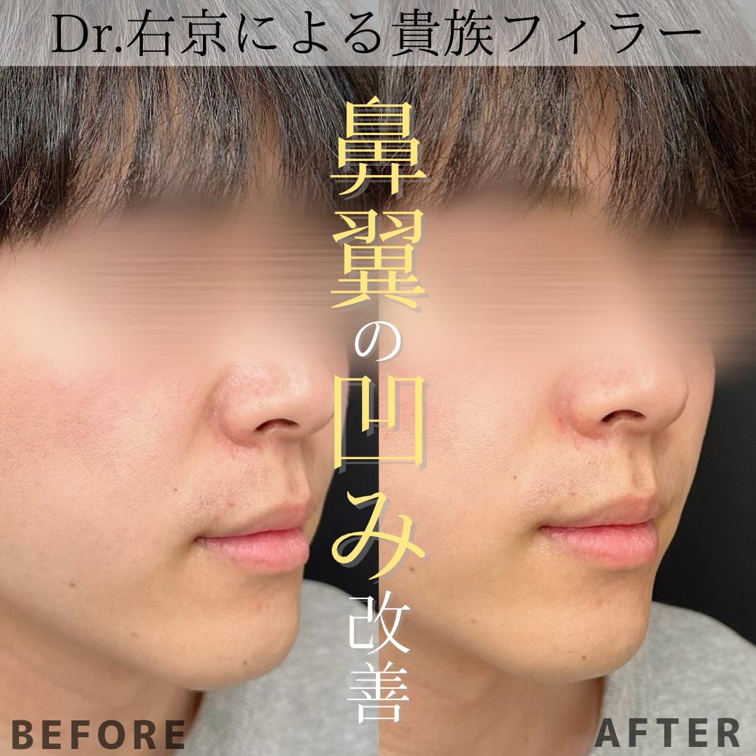 ヒアルロン酸の症例写真