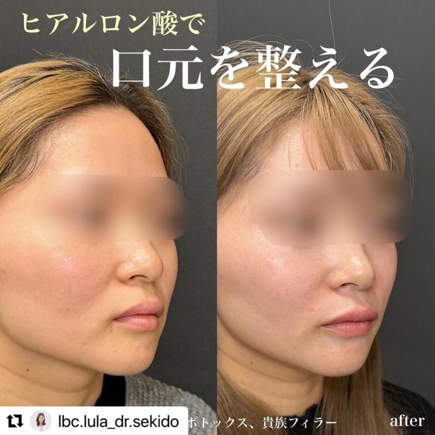 ヒアルロン酸の症例写真