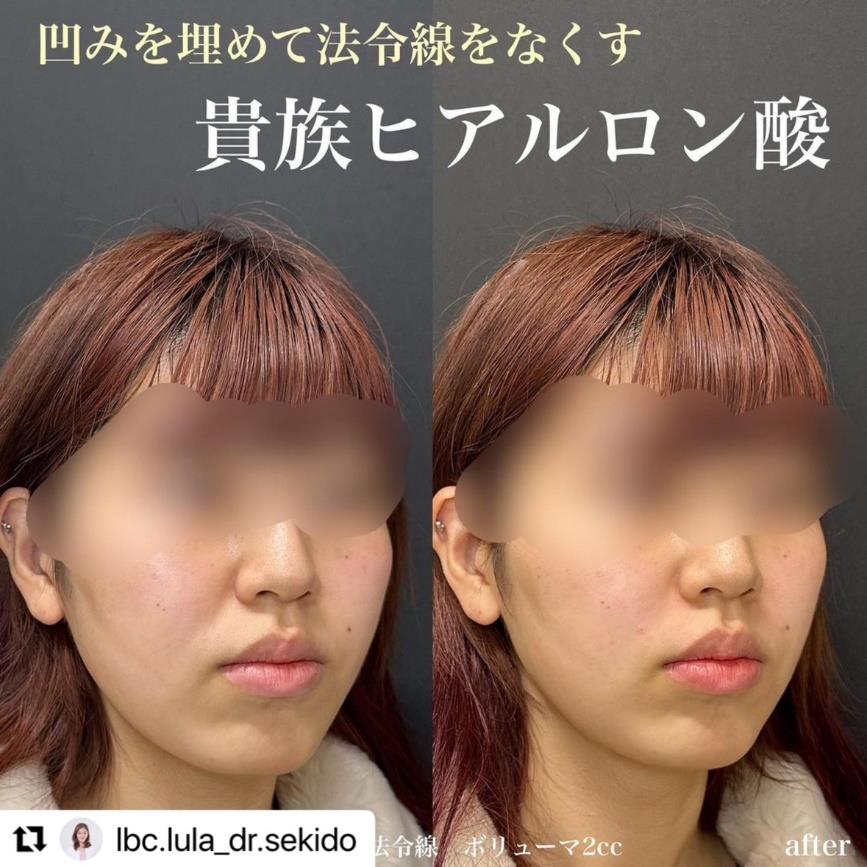 ヒアルロン酸の症例写真