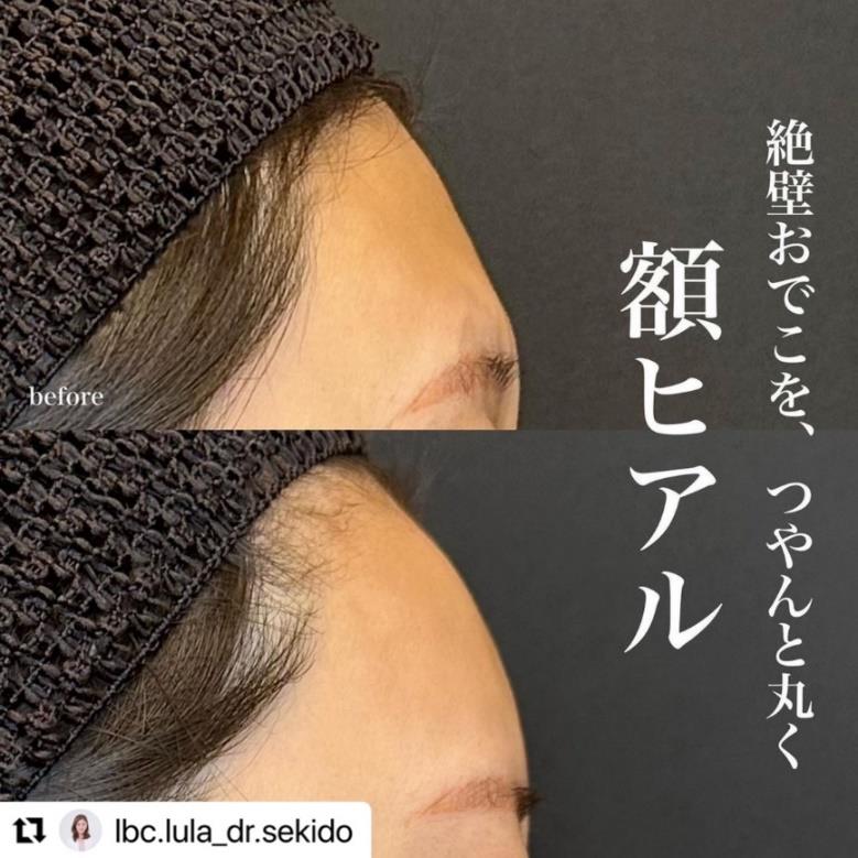 ヒアルロン酸の症例写真