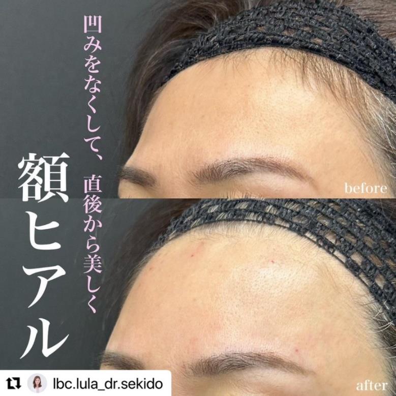 ヒアルロン酸の症例写真