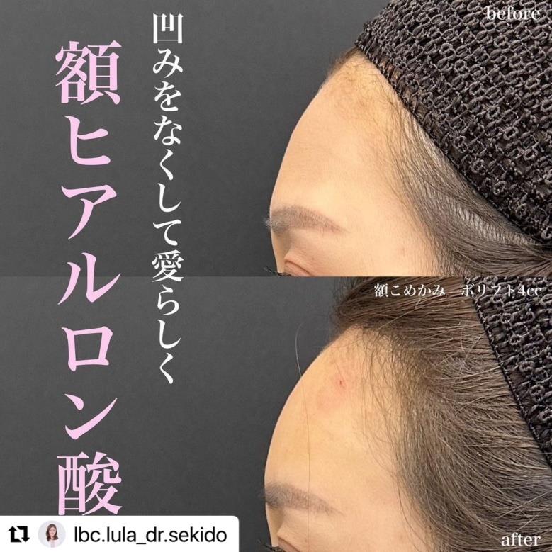 ヒアルロン酸の症例写真