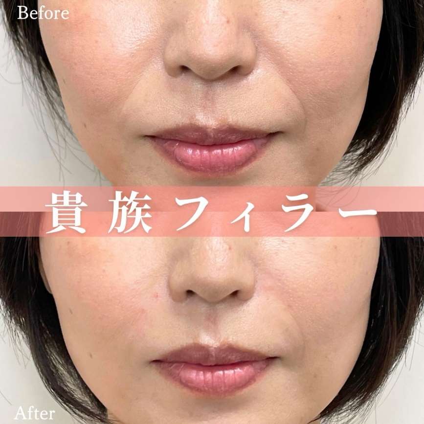 ヒアルロン酸の症例写真