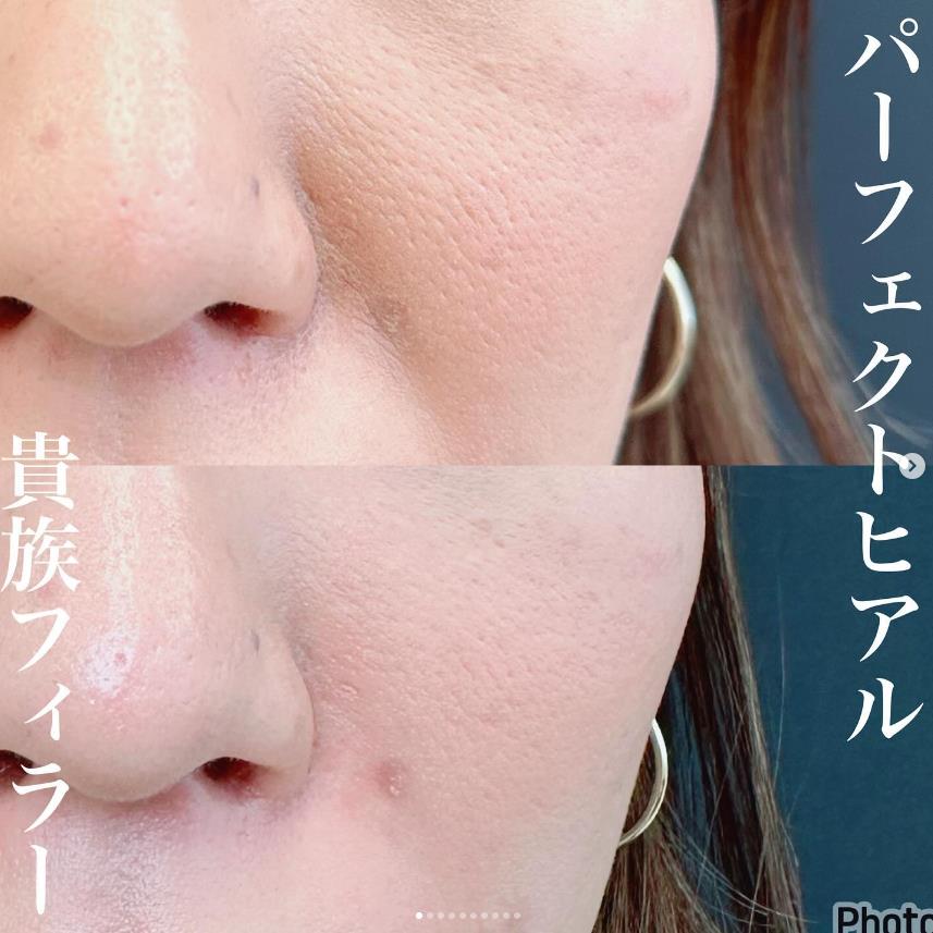 ヒアルロン酸の症例写真