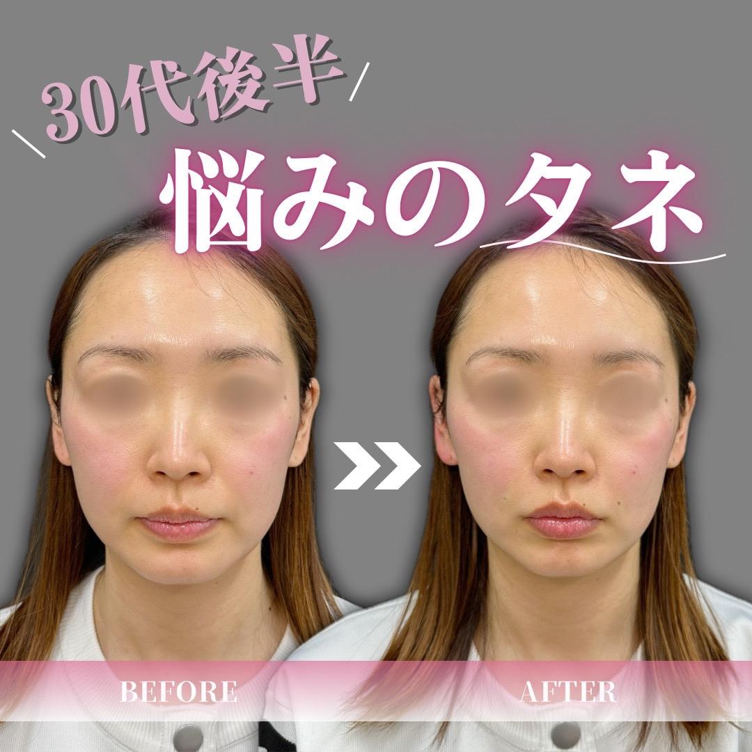 ヒアルロン酸の症例写真