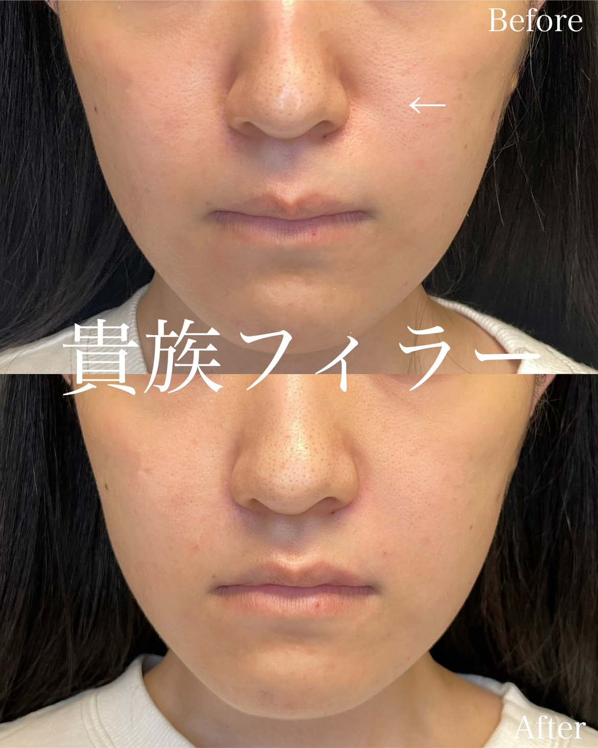ヒアルロン酸の症例写真