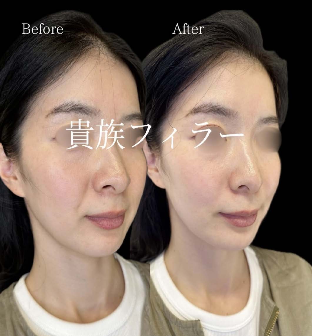 ヒアルロン酸の症例写真