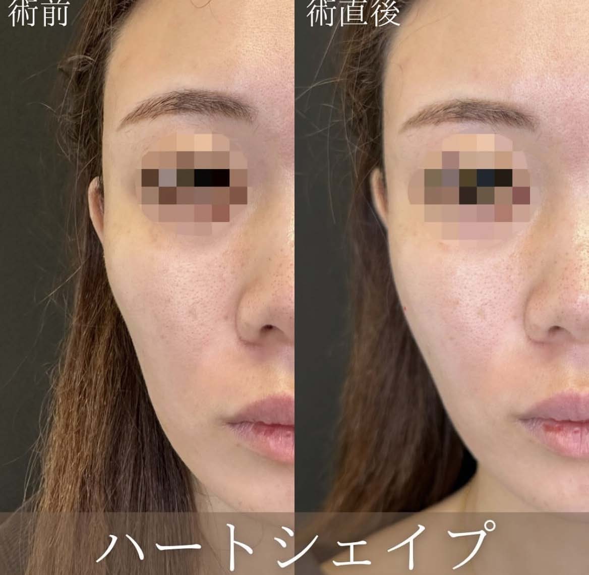 ヒアルロン酸の症例写真