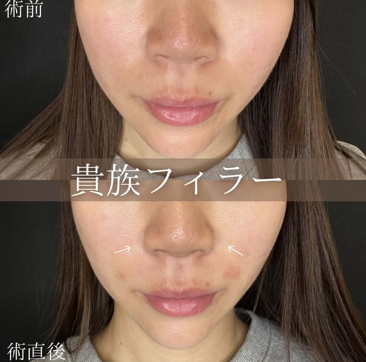 ヒアルロン酸の症例写真