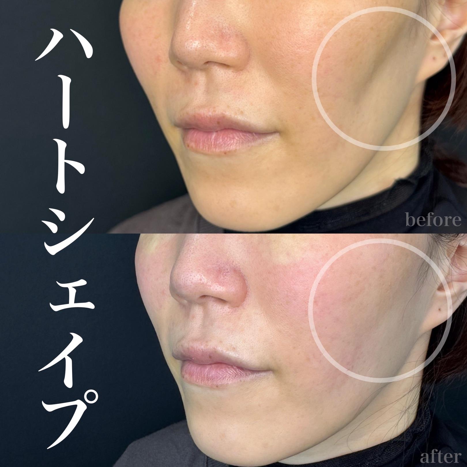 ヒアルロン酸の症例写真